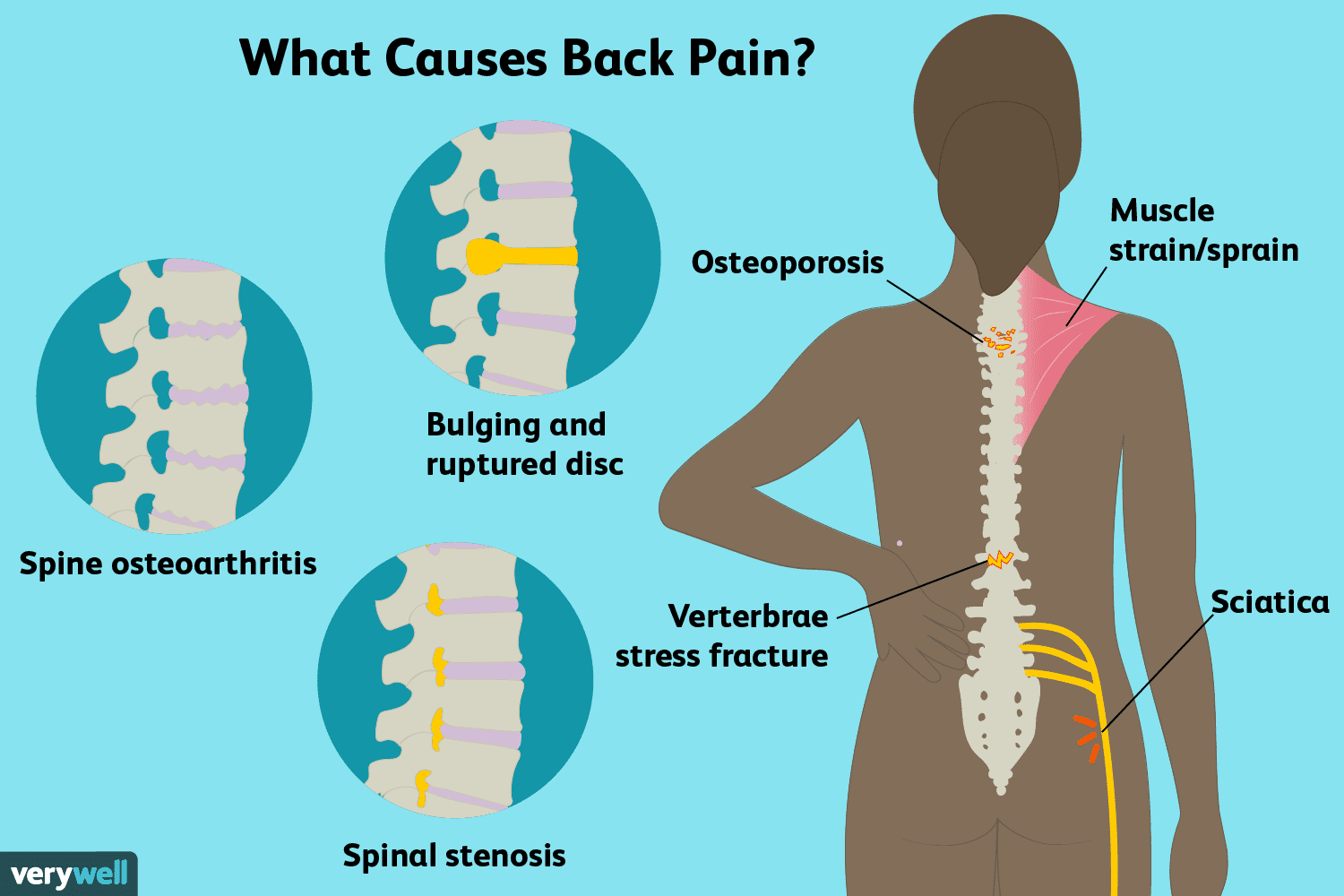 common-causes-and-treatment-of-lower-back-pain-rubmd