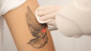 Tattoo Removal: Reasons to Remove Regret and Embrace Renewal in Vancouver