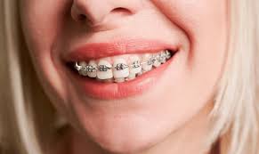 How Orthodontics Can Improve Overall Oral Health and Prevent Future Dental Issues