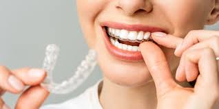 The Impact of Clear Aligners on Professional and Social Confidence