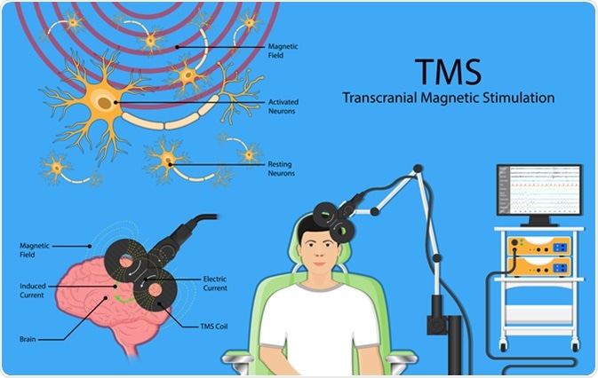 What to Expect During Transcranial Magnetic Stimulation Therapy: A Step-by-Step Guide