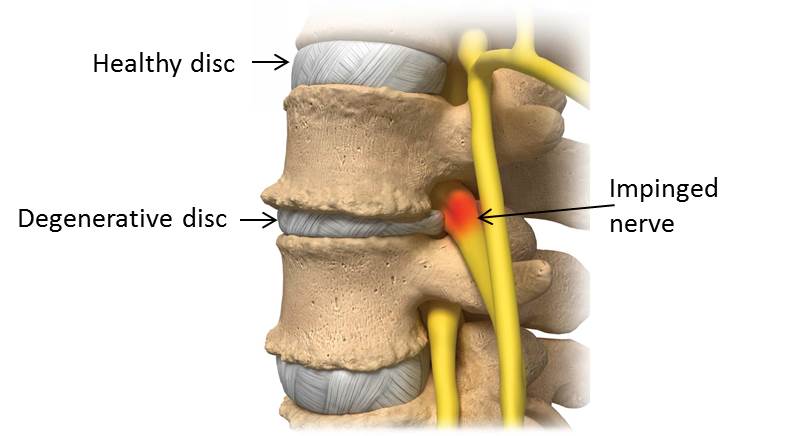 3 Symptoms of Degenerative Disc Disease