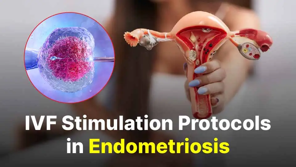 Does Endometriosis Prevent Successful IVF Treatment?