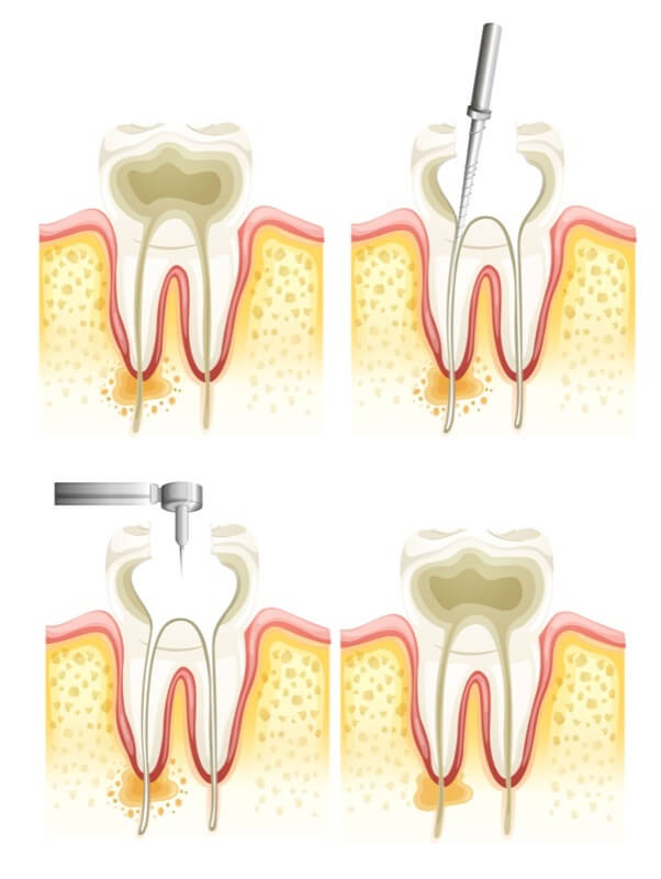 What Is an Endodontist?