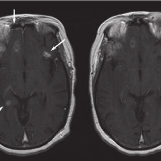 How Neuroradiology Assists in Detecting Brain Tumors