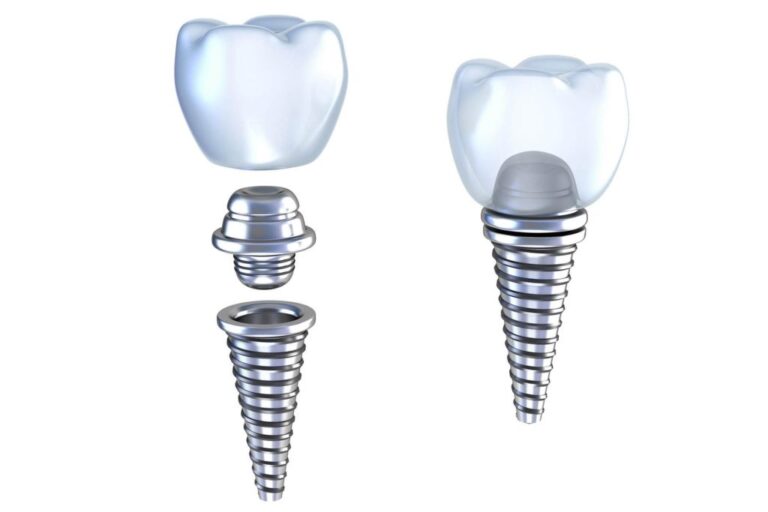 How Dental Implants Can Improve Your Quality of Life RubMD