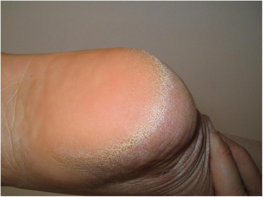 The Role of Urea and Emollients in Foot Creams for Cracked Heels