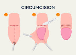Understanding Circumcision in Penrith: A Guide for Men's Wellness