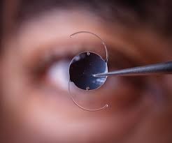 Intraocular Lens: A Clear Solution for Improved Eyesight