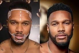 Afro Hair Transplant for Men vs Women: Key Differences